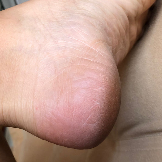 Como curar talones agrietados