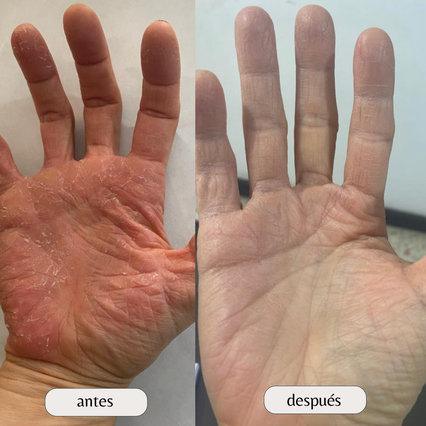Kit Dermatitis o Resequedad corporal y manos