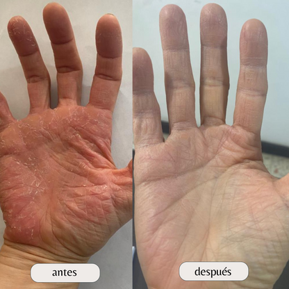 Kit Dermatitis o Resequedad corporal y manos