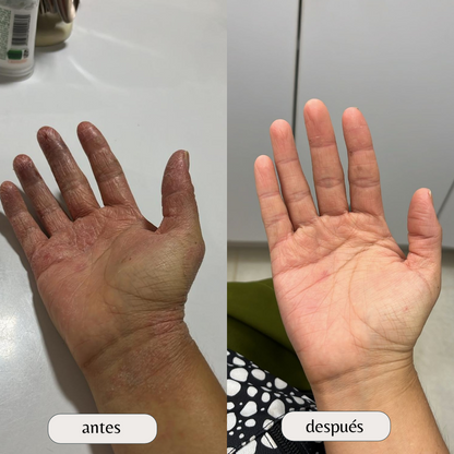 Kit para dermatitis y resequedad corporal