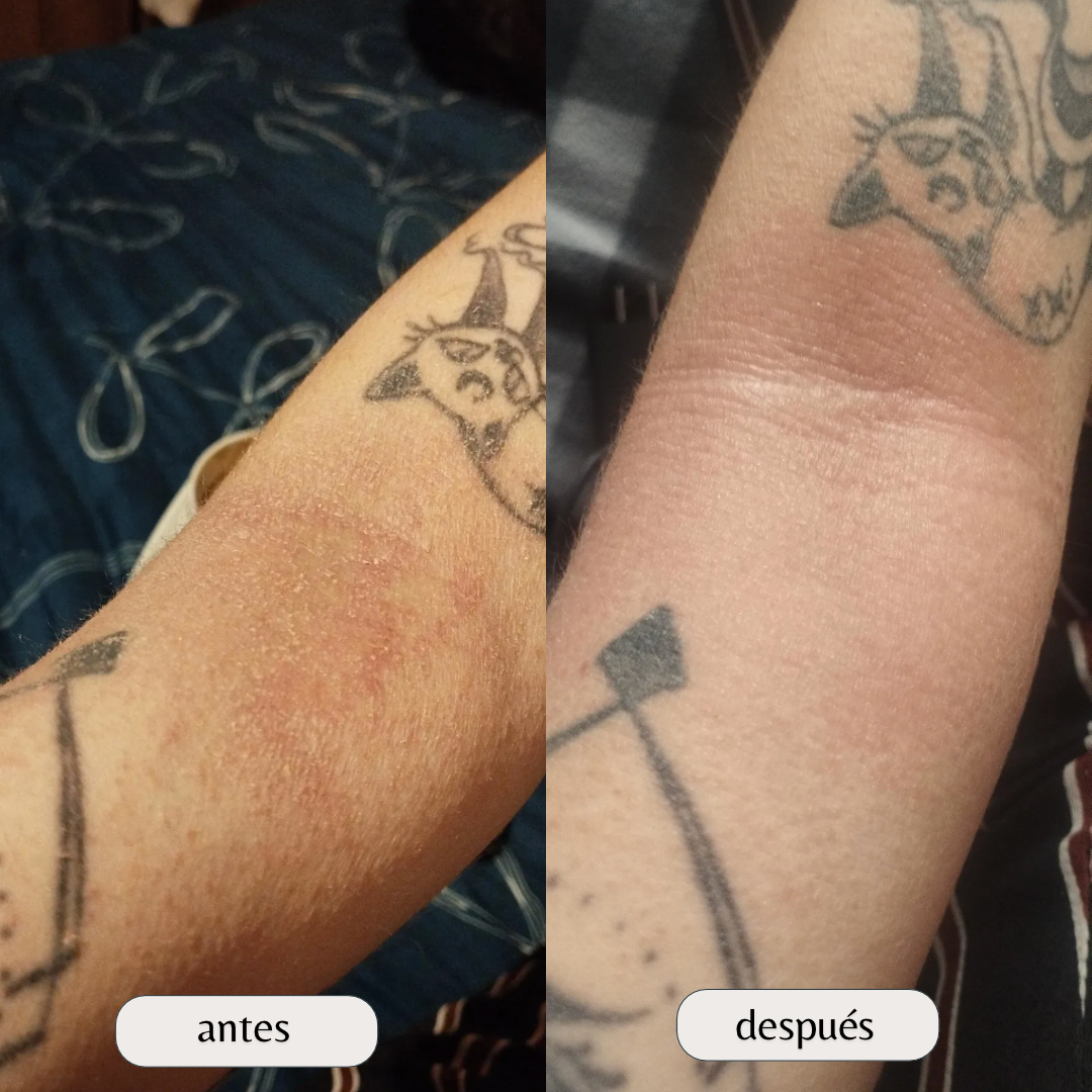 Kit para dermatitis y resequedad corporal
