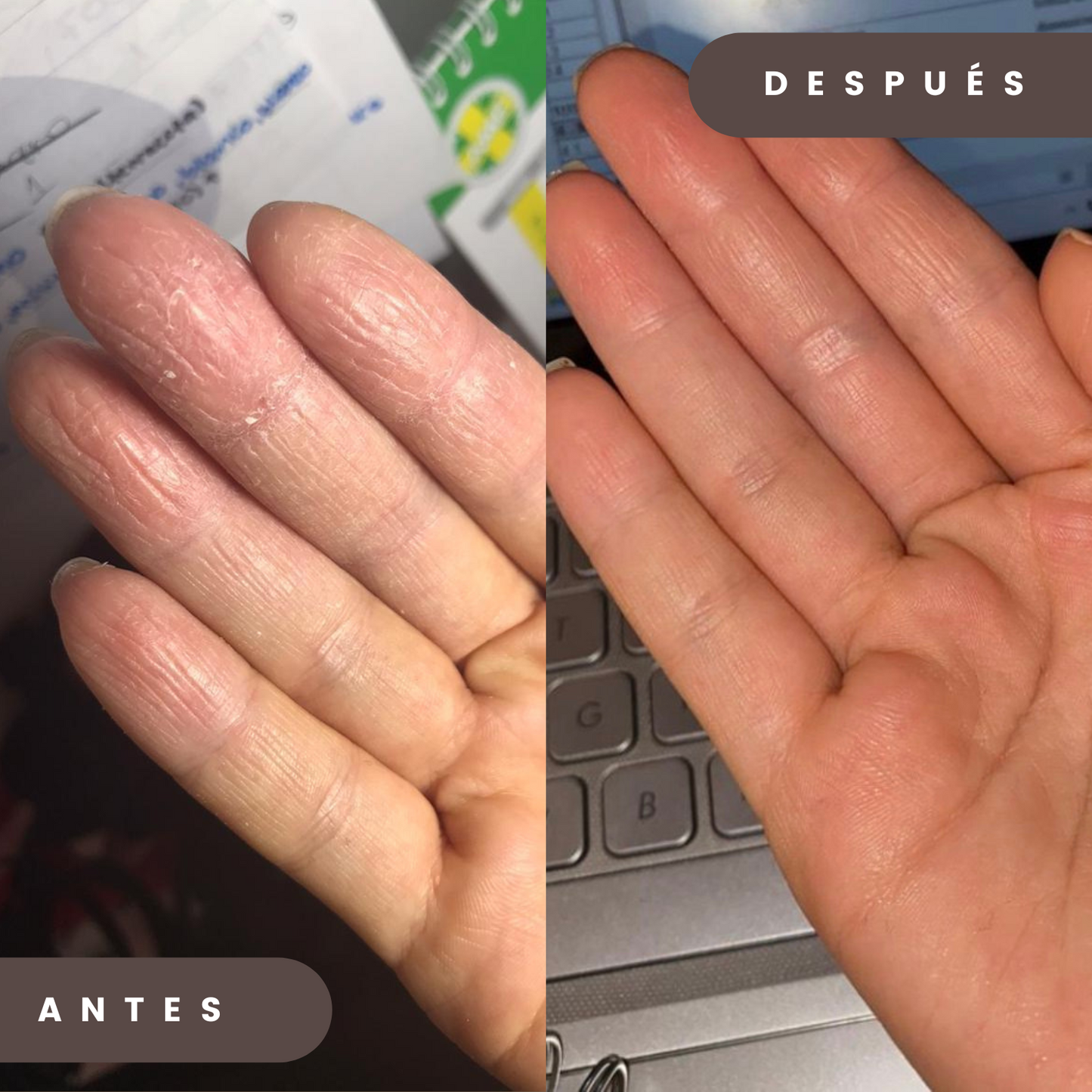 Kit Dermatitis o Resequedad